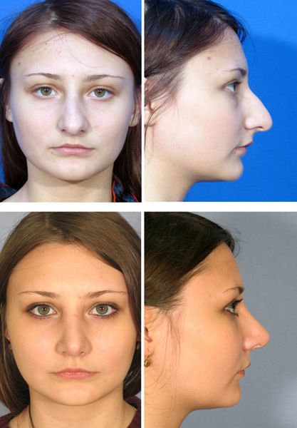 Пластика носа до и после фото женщины