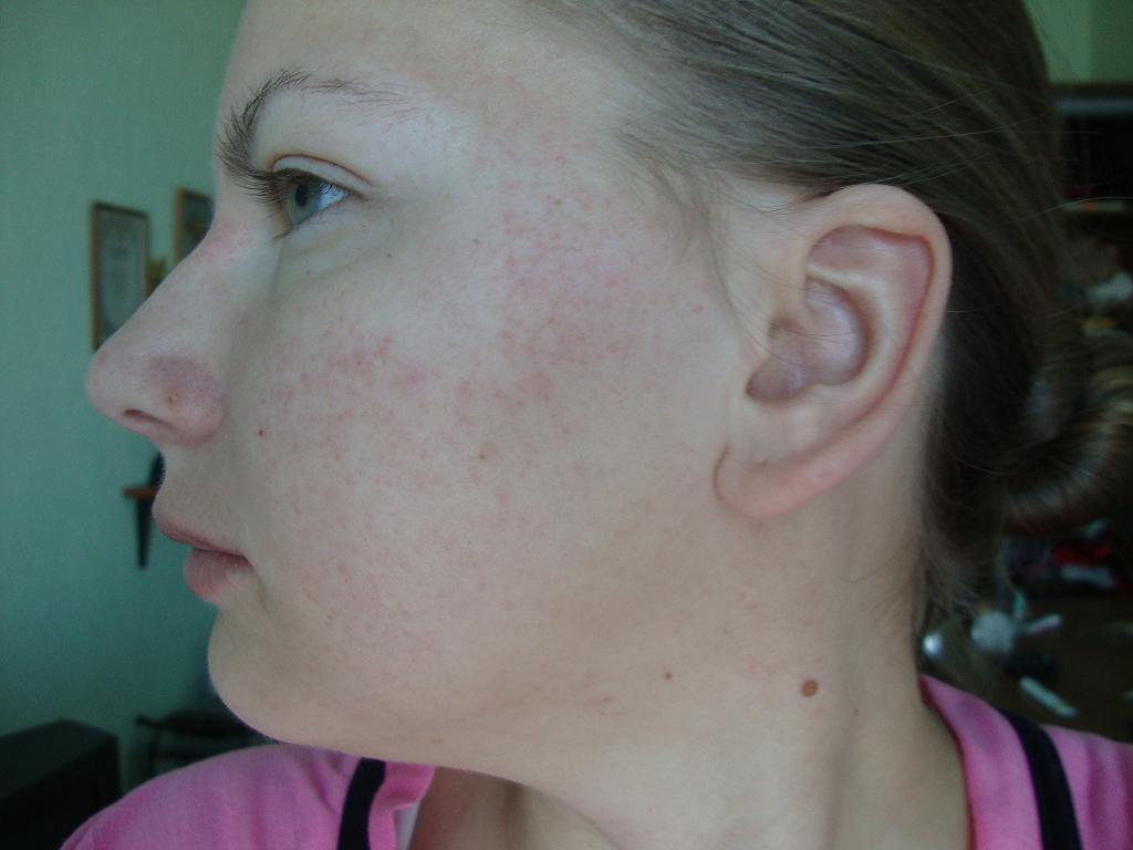 Znaczenie trądziku na twarzy: lokalizacja i opis.  Przyczyny trądziku w różnych obszarach twarzy.