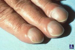 О чем говорят изменения ногтей на руках. О чём говорят наши ногти? По форме и структуре ногтя