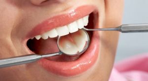 Как проходит профессиональная чистка зубов? Гигиена полости рта. Средства и методы профессионального удаления зубных отложений