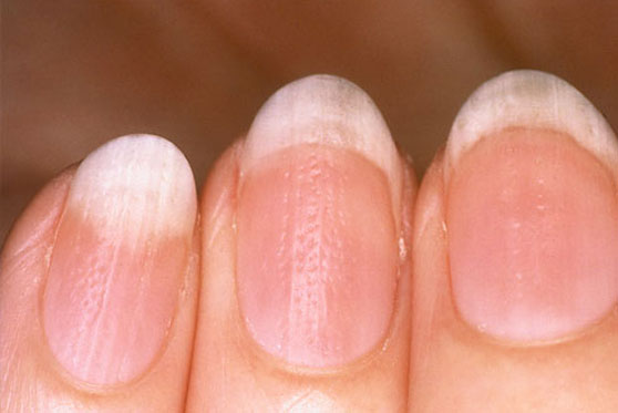 Что могут сказать ногти о здоровье человека. Лечение в домашних условиях. Диагностика деформации ваших ногтей